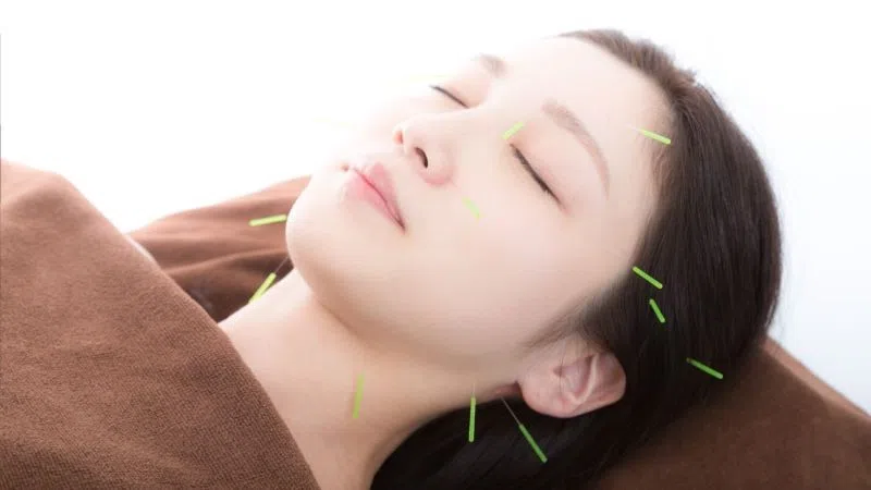 美容鍼の写真