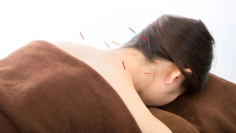 頭の鍼灸マッサージを受ける女性の写真